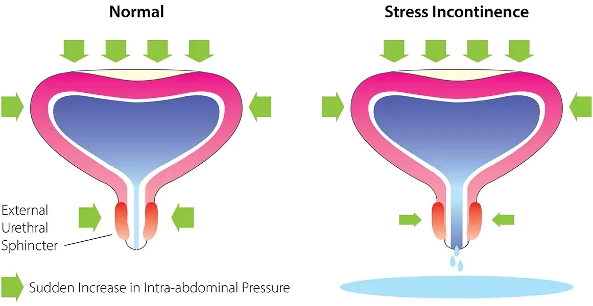 Urinary Incontinence